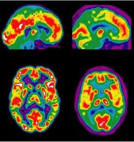  Le iniziative dell’AIMA, Con Ferderfarma e House Hospital,  per la giornata mondiale Alzheimer