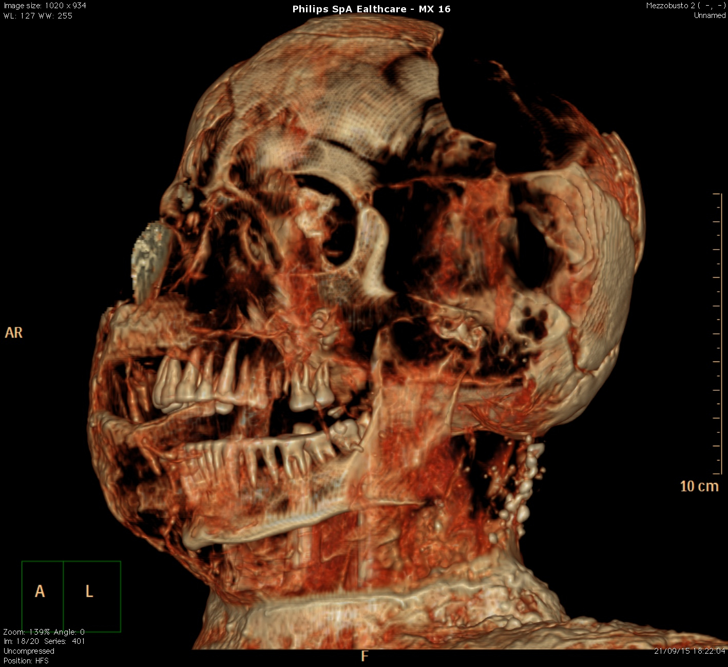  La scienza medica al servizio dell’archeologia: una TAC per studiare le vittime dell’eruzione di Pompei