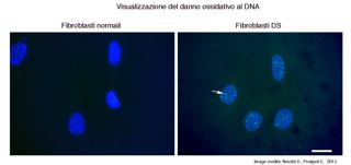  Sindrome di Down, studio dell’Igm-Cnr: è necessario prevenire i danni al DNA