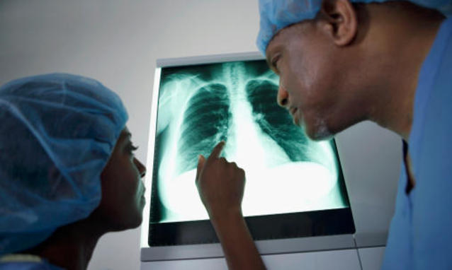  Tumore al polmone: dimostrato ruolo chiave di un oncogene